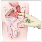 Prostatasimulation  funktioniert!.jpg